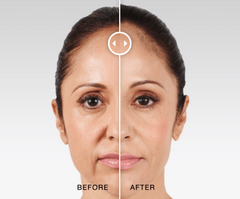 Before and after comparison of facial rejuvenation results, highlighting enhanced cheek volume and smoother skin texture, related to JUV&Eacute;DERM VOLUMA&reg; XC treatment for age-related volume loss.